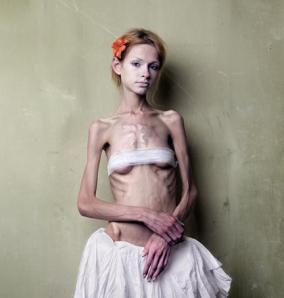anorexia1-gif