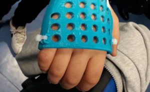 esoscheletro-santobono