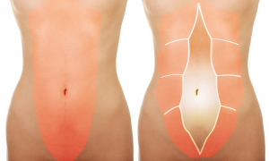 diastasi_dei_retti_addominali