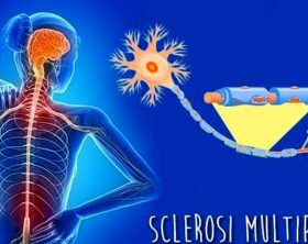 sclerosi-multipla-1-1
